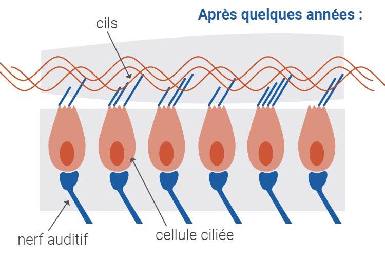 Cellule ciliée endommagée